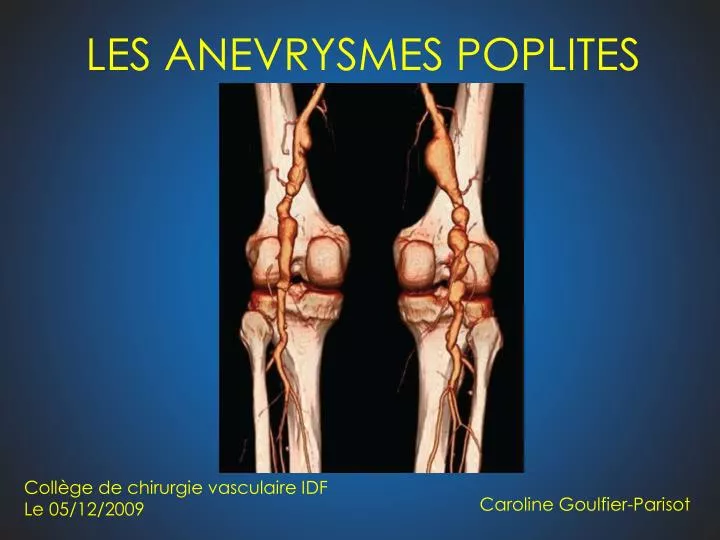 les anevrysmes poplites