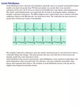 Atrial Fibrillation