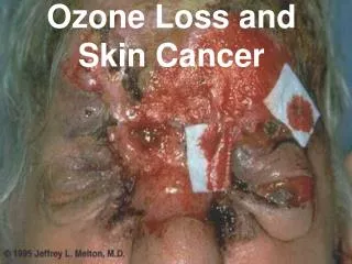 Ozone Loss and Skin Cancer