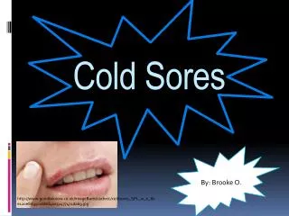 Cold Sores