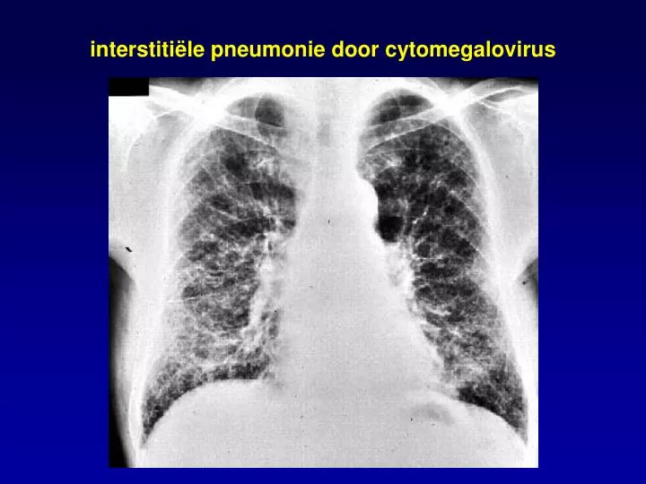 interstiti le pneumonie door cytomegalovirus