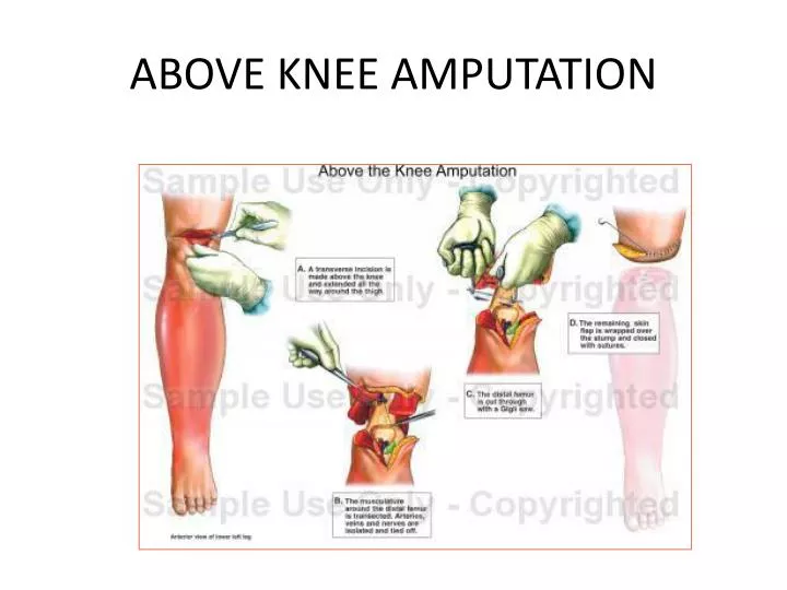 above knee amputation