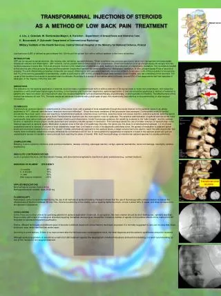 TRANSFORAMINAL INJECTIONS OF STEROIDS AS A METHOD OF LOW BACK PAIN TREATMENT