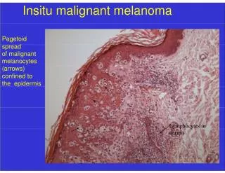 Insitu malignant melanoma
