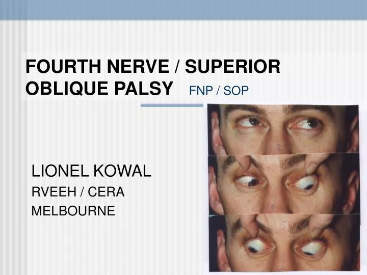 fourth nerve superior oblique palsy fnp sop