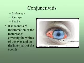 Conjunctivitis