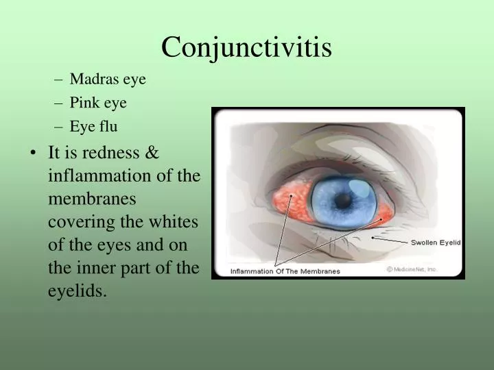 Ppt Conjunctivitis Powerpoint Presentation Free Download Id6587871 