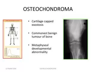 OSTEOCHONDROMA