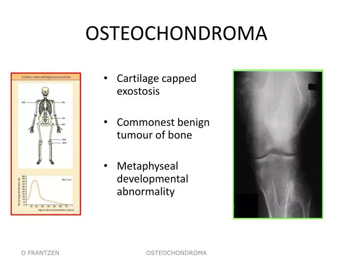osteochondroma