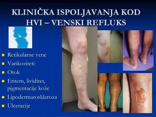 klini ka ispoljavanja kod hvi venski refluks