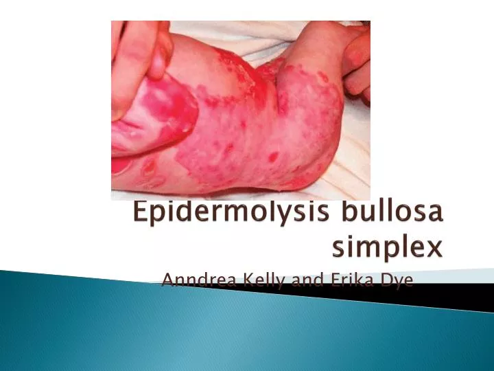 epidermolysis bullosa simplex