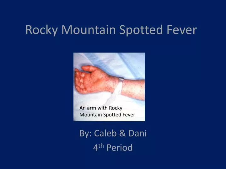 rocky mountain spotted fever