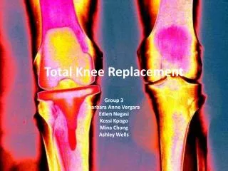 Total Knee Replacement