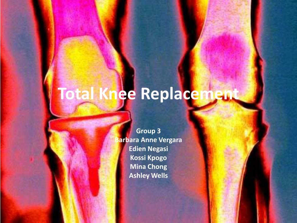 PPT - Total Knee Replacement PowerPoint Presentation, free download ...