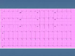 Cardiac Tamponade