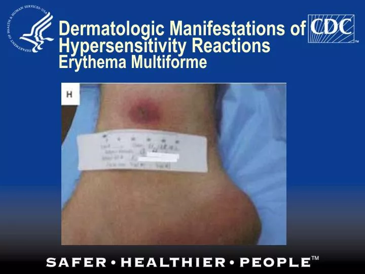 dermatologic manifestations of hypersensitivity reactions erythema multiforme