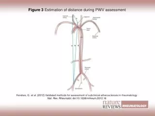 Figure 3 Estimation of distance during PWV assessment