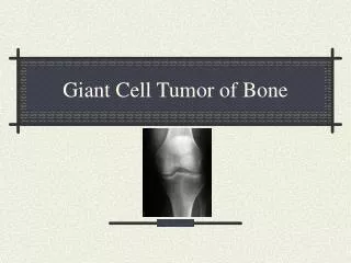 Giant Cell Tumor of Bone