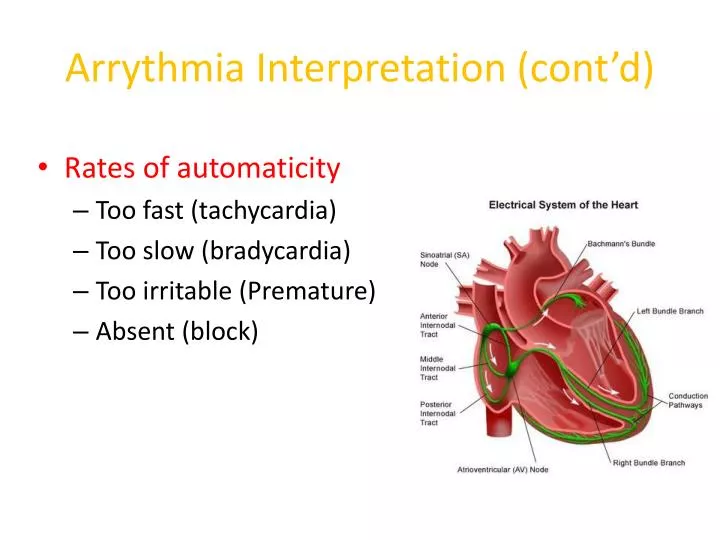 arrythmia interpretation cont d