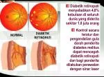 NORMAL - slide 1