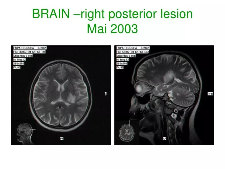 brain right posterior lesion mai 2003