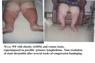 76 y.o. WF with obesity, AODM, and venous stasis,