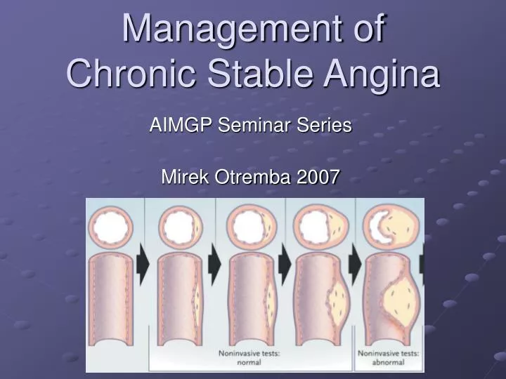 management of chronic stable angina