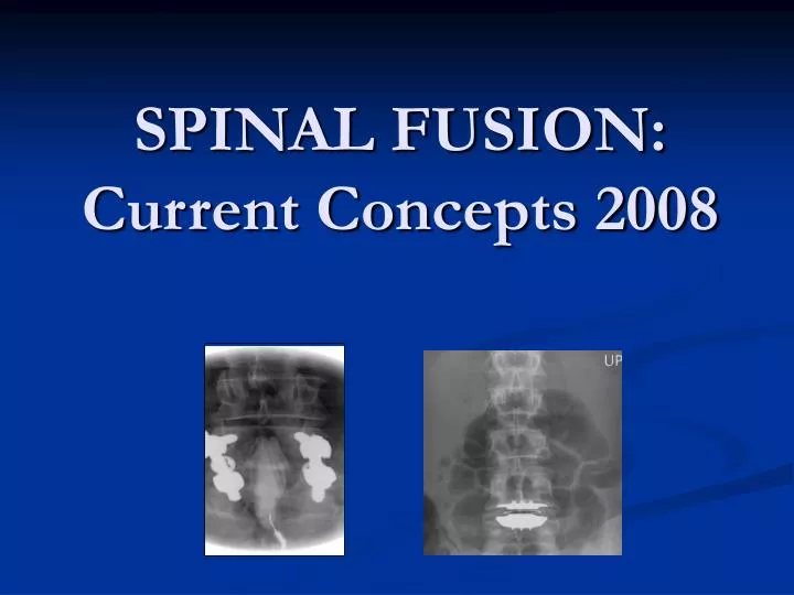 spinal fusion current concepts 2008