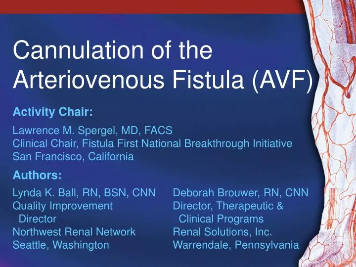 cannulation of the arteriovenous fistula avf