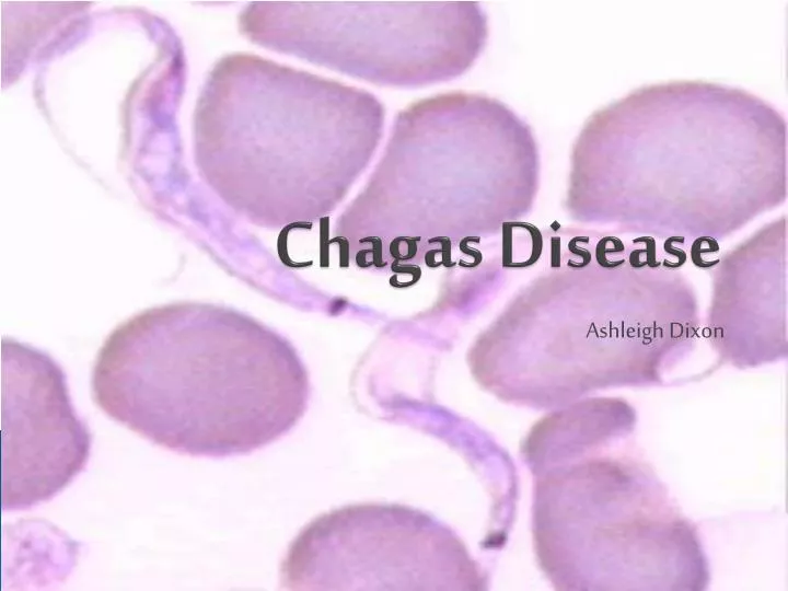 chagas disease
