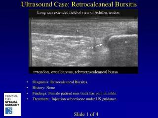 Ultrasound Case: Retrocalcaneal Bursitis