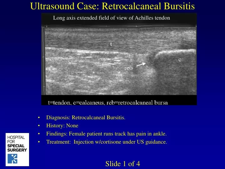 ultrasound case retrocalcaneal bursitis