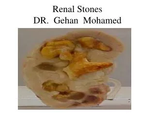 Renal Stones DR. Gehan Mohamed