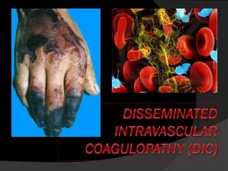 Disseminated intravascular coagulopathy (DIC)