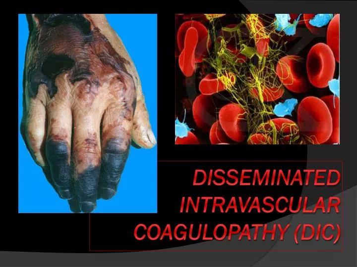 disseminated intravascular coagulopathy dic
