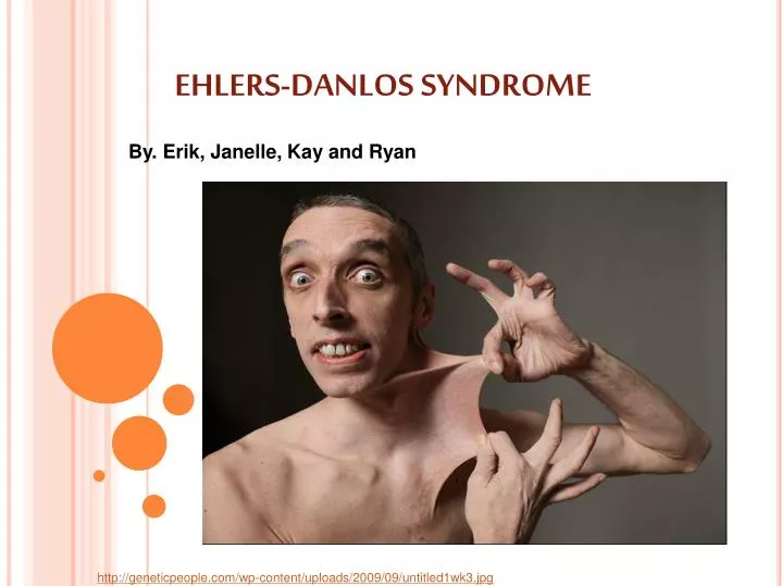 ehlers danlos syndrome