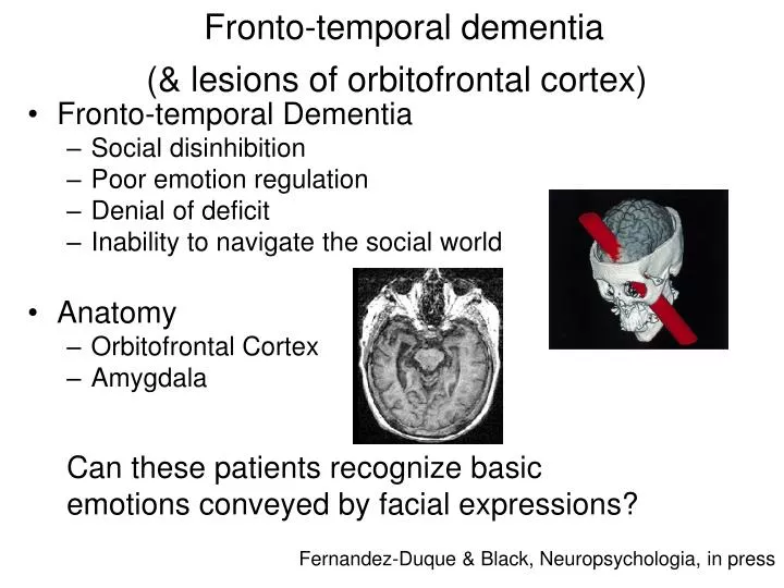fronto temporal dementia lesions of orbitofrontal cortex