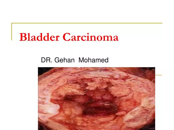 bladder carcinoma