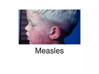 measles