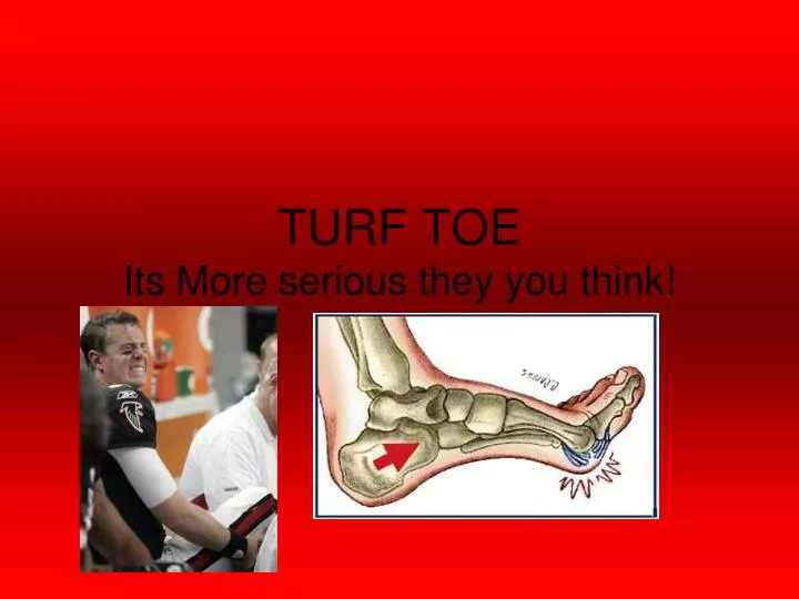 turf toe its more serious they you think