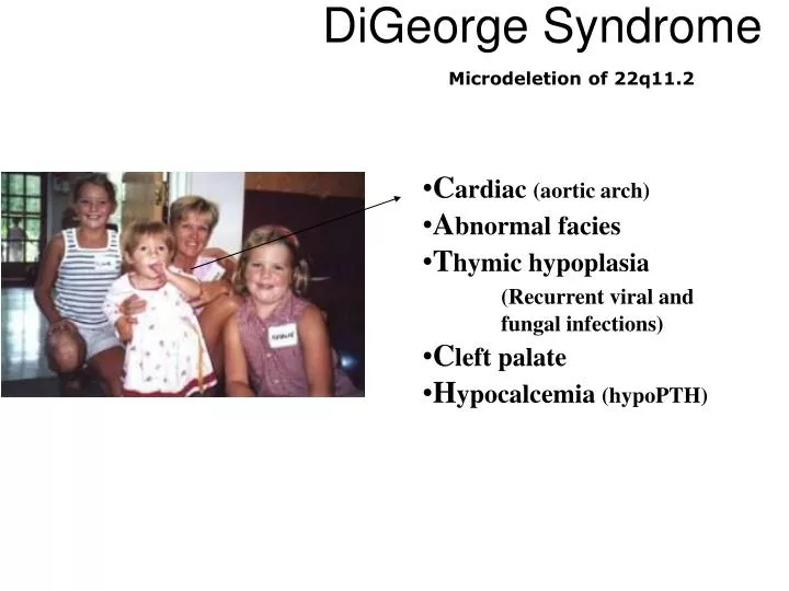 digeorge syndrome
