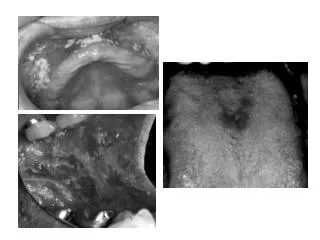 Candidiasis Appearance: Removable creamy-white plaque (pseudomembranous)