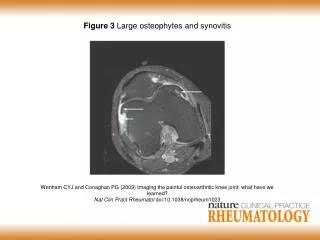 Figure 3 Large osteophytes and synovitis