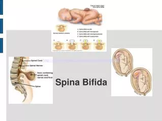 Spina Bifida