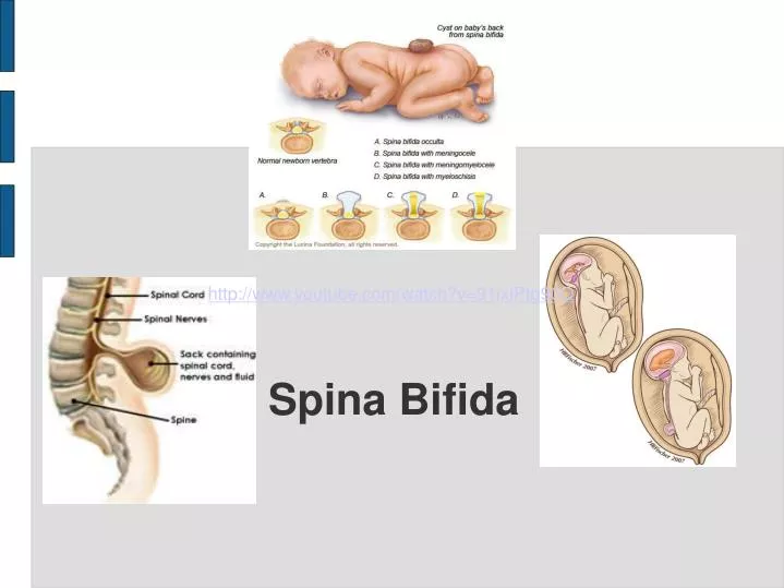 spina bifida