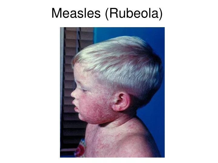 measles rubeola