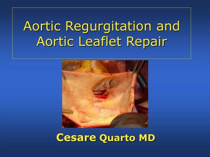 aortic regurgitation and aortic leaflet repair