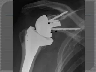 Reverse Total Shoulder Arthroplasty