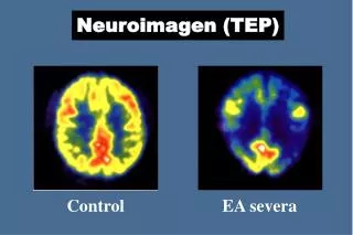 neuroimagen tep