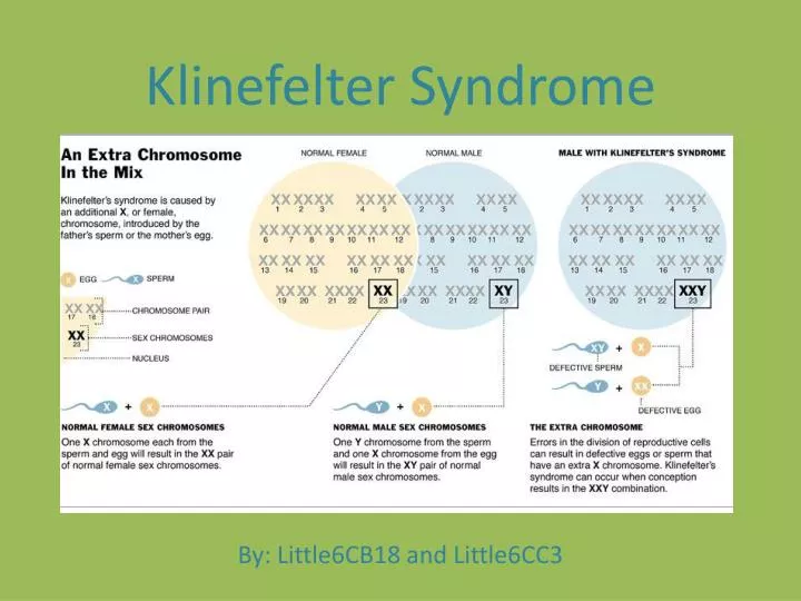 klinefelter syndrome